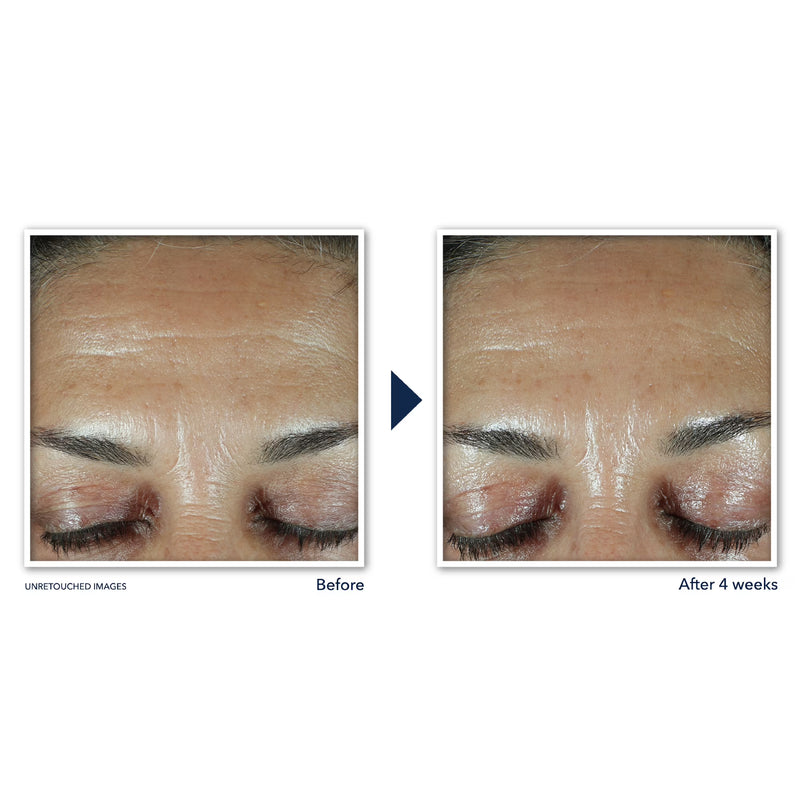 RoC Retinol Correxion Deep Wrinkle Filler for Fine Lines and Anti-Aging, 1.0 fl oz